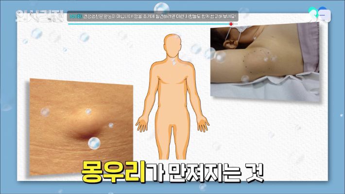 2025 의사결정 추석특집 '암 몰아보기' 편 유튜브 캡처