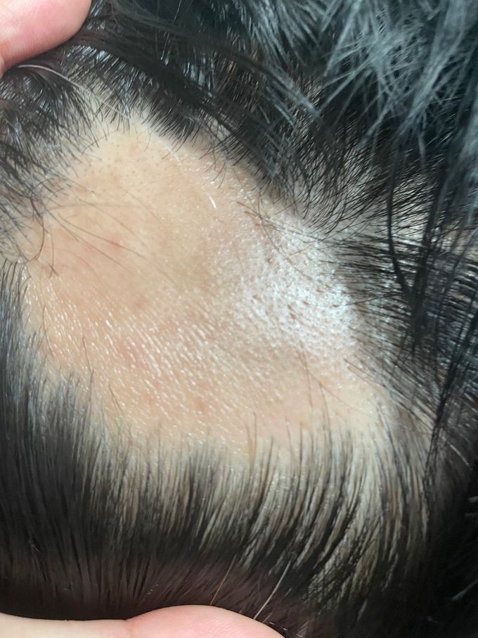 정수리 부분에 발생한 탈모. 모더나의 신종 코로나바이러스 감염증(코로나19) 백신 2차 접종 후 약 2주쯤 지난 모습이라고 제보자는 전했다. 제보자 제공