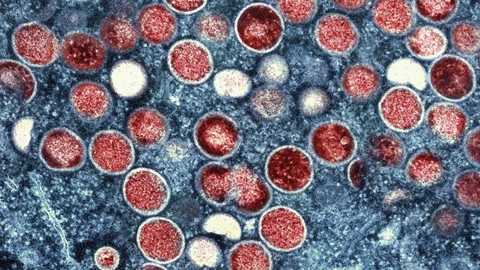 세계보건기구(WHO)는 27일(현지시간) 원숭이두창 발병 사례가 78개국에서 1만8천 건을 넘어서는 등 확산세를 이어가고 있다고 밝혔다. 미 국립알레르기·전염병연구소(NIAID) 제공