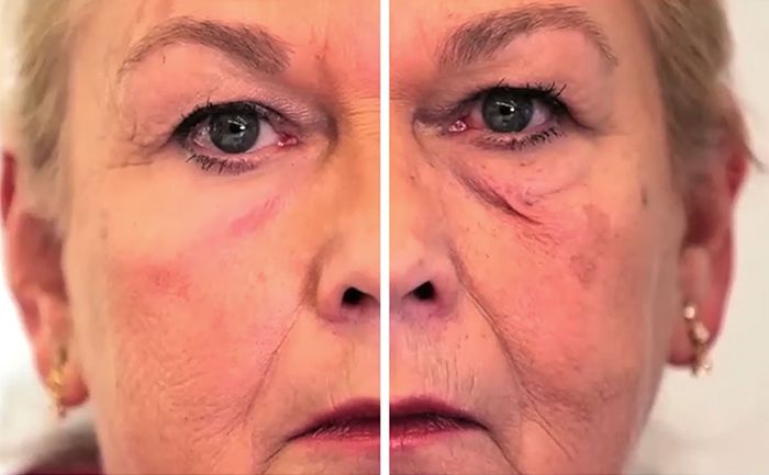 인공 막을 사용한 왼쪽과 사용하지 않은 오른쪽. 출처=http://www.self.com