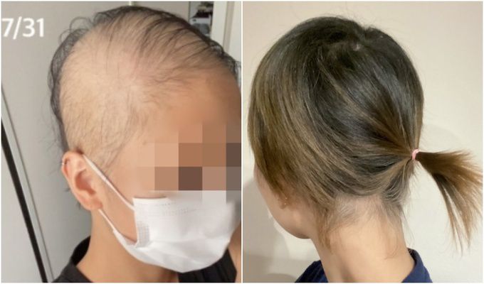 지난해 6월 신종 코로나바이러스 감염증(코로나19) 모더나 백신 1차 접종 후 탈모 증상을 호소했던 일본 여성 A씨가 올해 10월 모발이 많이 자라난 근황을 알렸다.(오른쪽 사진) A씨 블로그 갈무리