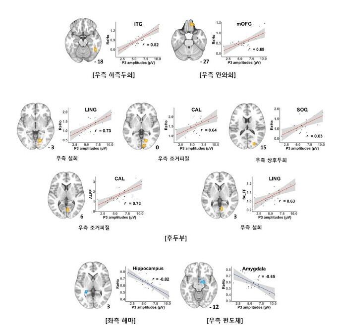 기능적 MRI와 뇌파검사 결과 우측 하측두회, 우측 안와회 및 일부 후두부에서 모두 유의미한 양의 상관관계를 보였다(노란색/빨간선). 좌측 해마와 우측 편도체에서는 두 검사 결과 사이의 음의 상관관계를 보였다(파란색)>
