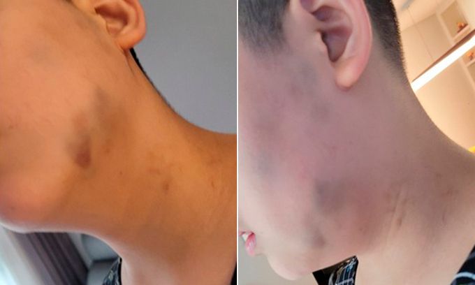 특수학교에 다니는 중학생의 얼굴과 발 등 온몸에서 발견된 멍 자국. 전국장애인부모연대 대구지부 제공