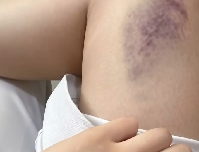 A씨가 친구에게 “누군가한테 맞았다”며 보낸 사진.