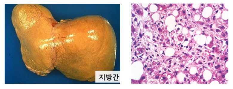 적출된 지방간(왼쪽)과 지방간염의 현미경 소견. 명지병원 제공