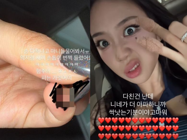 이영지가 손톱 부상 소식을 전했다. 인스타그램 캡처.