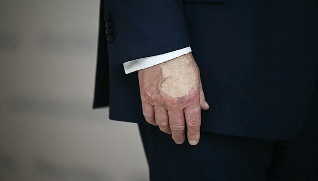 도널드 트럼프 미국 대통령의 오른쪽 손등에 피부색과 맞지 않는 메이크업 자국이 남아있다. X 캡처