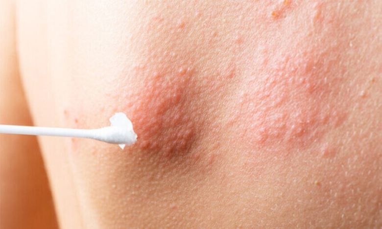 몸통 부위에 띠 모양으로 발생한 대상포진. 국가건강정보포털 제공