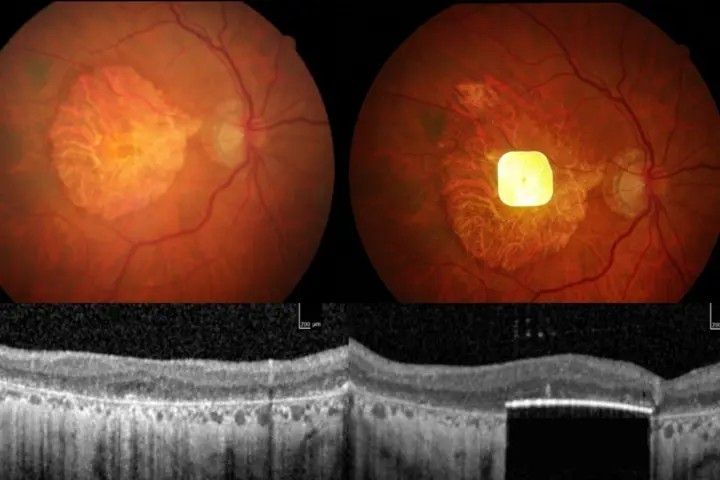칩 삽입 전(왼)과 후의 모습. 사진=무어필즈 안과병원 홈페이지 캡처