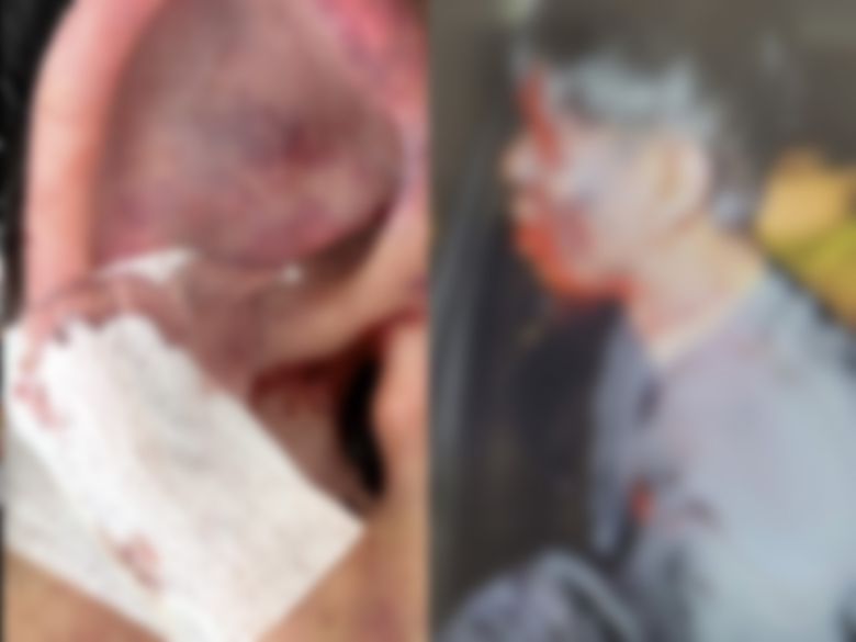 폭행 직후 귀 내부 출혈·안와 골절 등 중상을 입은 피해자의 모습. 유튜버 수탉 제공