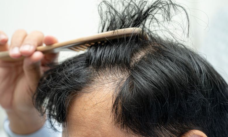 탈모 환자. 게티이미지뱅크