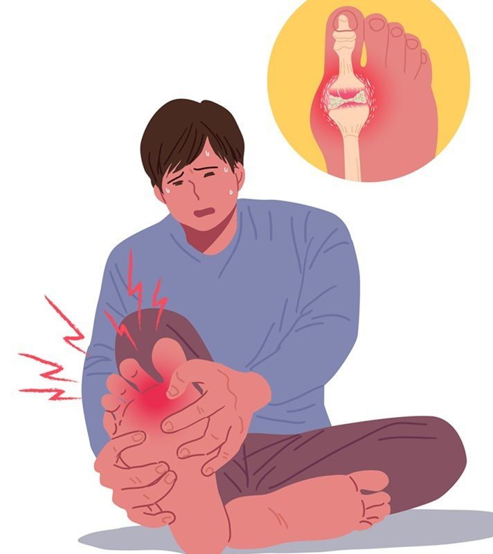 통풍은 대부분 엄지발가락에 염증이 생겨 이후 팔꿈치나 발목, 무릎 관절 등으로 통증이 번지곤 한다. 게티이미지뱅크