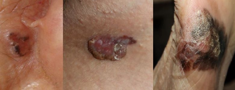 사진 왼쪽부터 기저세포암, 편평세포암, 악성흑색종