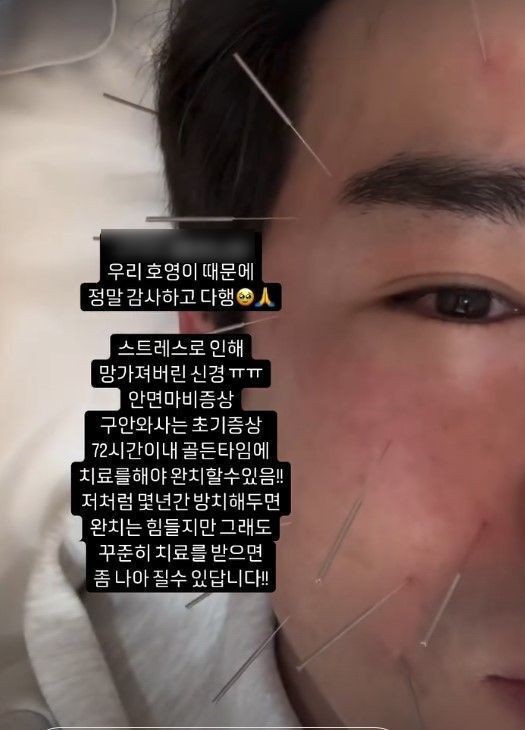 이민우가 힘겨운 심정을 토로해 안타까움을 자아냈다. 사진은 이민우가 지난 3월 자신의 SNS를 통해 공개한 스트레스로 인한 안면마비 증상으로 침 치료를 받고 있는 모습. 사진=이민우 인스타그램 캡처