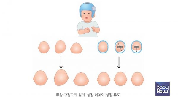 두상교 교정모의 원리: 성장 제어와 성장 유도. ⓒ임신영