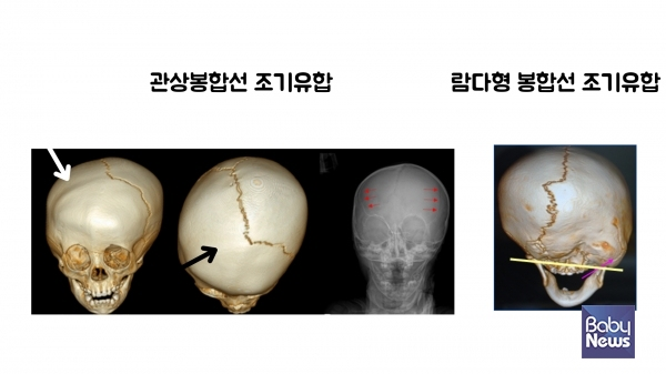 관상봉합선 조기유합과 람다형 봉합성 조기유합 비교. ⓒ임신영