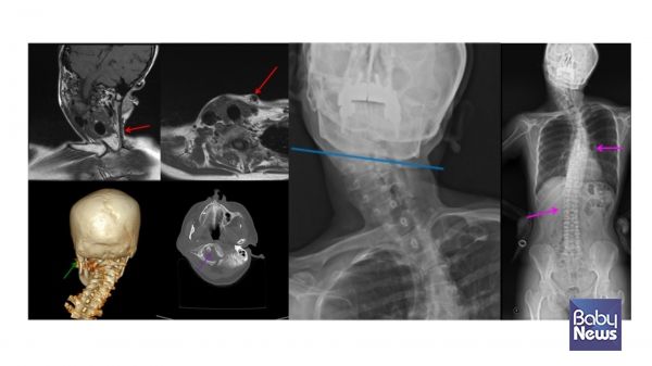 좌측 근성사경으로 인한 측경, 척추측만증 및 두개골 변형. ⓒ임신영