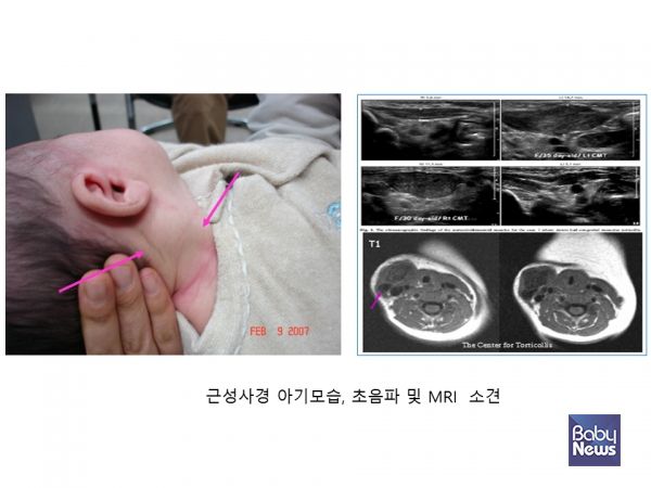 근성사경 아기모습, 초음파 및 MRI 소견. ⓒ임신영