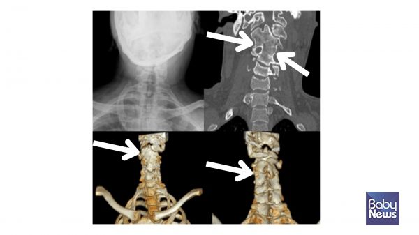 목뼈의 분절 이상을 보이는 클리펠-파일 증후군. ⓒ임신영