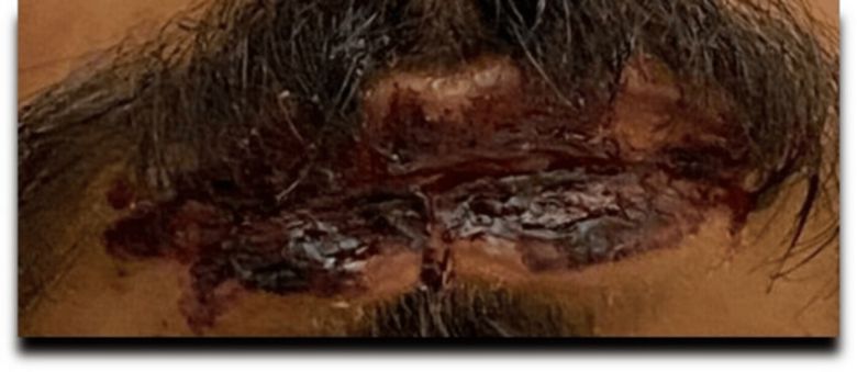 환자의 입술. 사진=Cureus