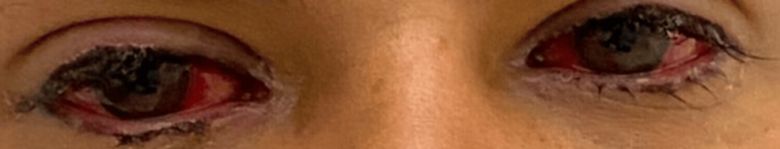 환자의 눈. 사진=Cureus