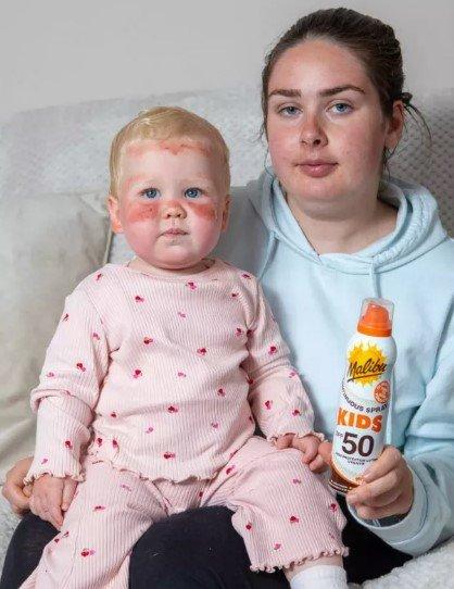 화상을 입은 딸과 사진을 찍은 로렌 리시먼(22). 로렌 인스타그램 캡처