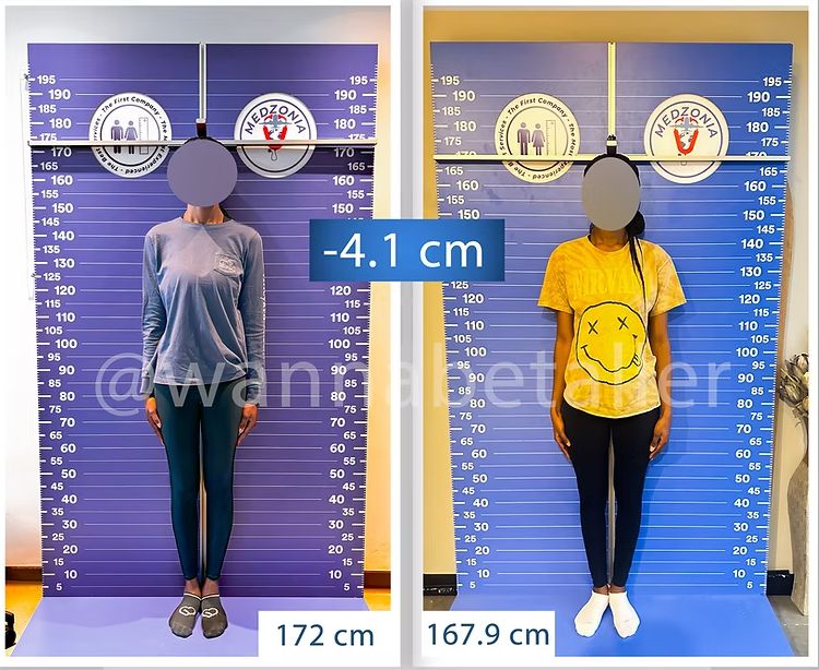 터키 병원에서 실제 ‘키 축소 수술’을 받은 미국 여성 A씨의 전후 사진. 수술 전(172㎝)에서 수술 후(167.9㎝)로 약 4.1㎝ 줄었다. [Height Reduction 공식 홈페이지]