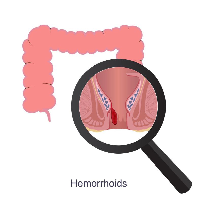 일반적으로 치질로 부르는 치핵은 항문 및 직장에 존재하는 치핵 조직이 항문 밖으로 빠져나오는 내치핵과 항문 밖의 치핵 조직이 부풀어 올라 덩어리처럼 만져지는 외치핵으로 구분된다. 사진=게티이미지코리아.