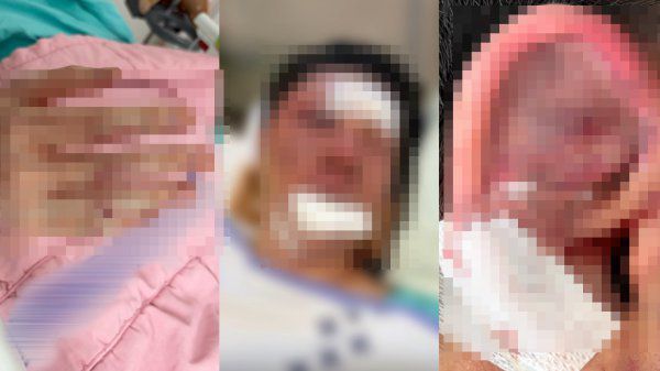 수탉이 공개한 당시 부상 상태. 피의자 A 씨 일당이 얼굴과 귀 부근을 무차별 폭행하는 과정에서 얼굴에 부상을 입었고, 이를 막으려다 손목 골절상을 입었다. 숲 수탉 채널 갈무리