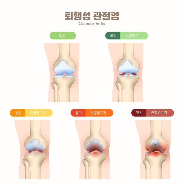 퇴행성 관절염 단계별 증상, 사진=게티이미지코리아.