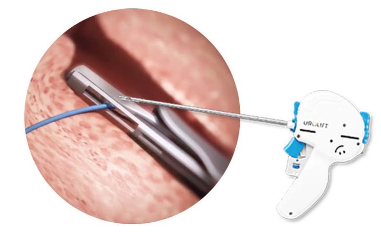 유로리프트는 전립선비대증으로 좁아진 요도 공간을 전립선 측엽을 고정해 확보하는 비절개 방식 치료로 조직을 절제하지 않고 시술한다.