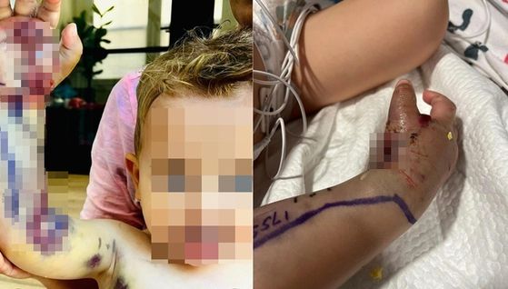 미국 샌디에이고에서 방울뱀에 물려 치료를 받은 2세 아이. 〈사진=린제이페퍼 인스타그램 캡처〉