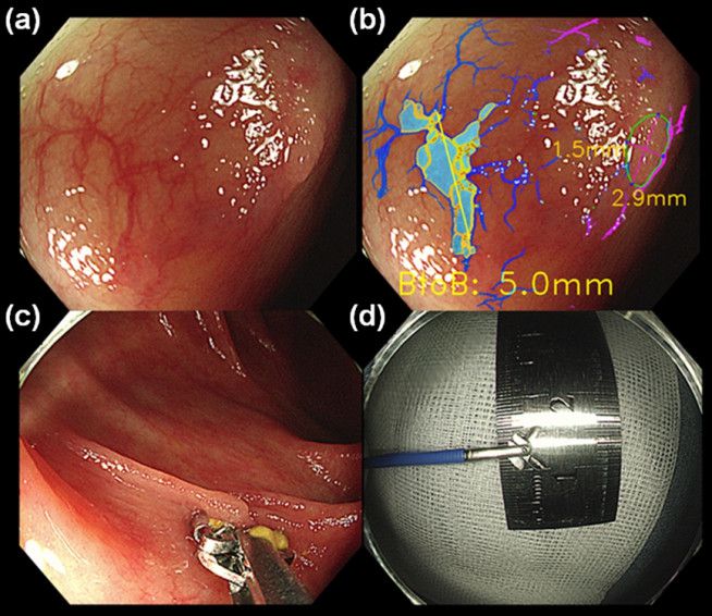 대장내시경 사진(a)에서 AI가 주변 혈관을 분석해 용종 크기를 측정한 모습(b), 개방형 생검 겸자를 통해 측정한 방법(c), (d)과도 일치하는 결과를 보여준다. (사진(d) 의 길이 6mm는 직경이므로, 1/2이 용종 크기이다)