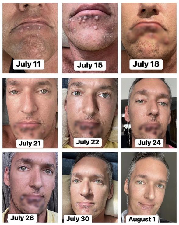 실버 스틸이 공개한 원숭이두창 감염 과정.