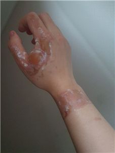 ▲고온‧고압의 스팀을 배관에 주입하다 2도 화상을 입은 한전KPS비정규직지회 조합원의 오른손 모습. ⓒ대책위