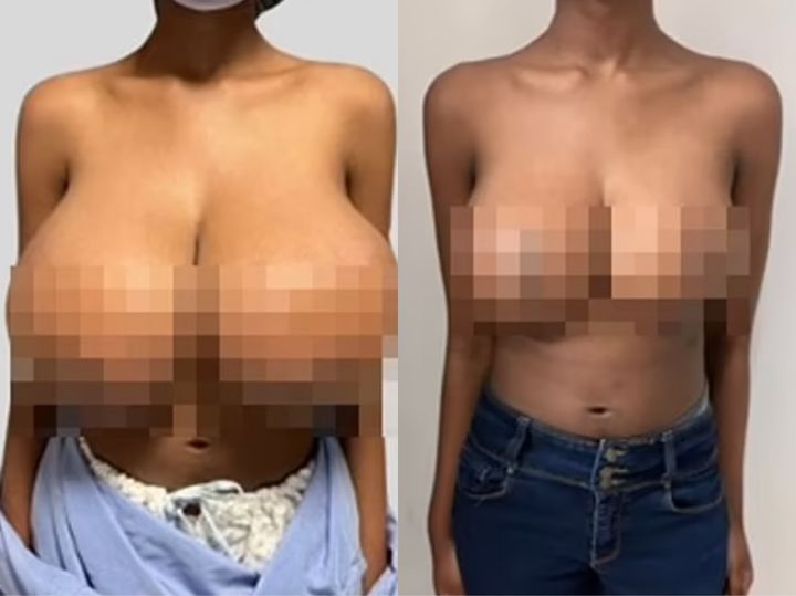 [서울=뉴시스] 캐나다 출신 19세 여성은 코로나19 화이자 백신을 두 차례 접종한 뒤 가슴 크기가 B컵에서 트리플 G컵으로 커지는 부작용을 겪었다. (사진=데일리메일) *재판매 및 DB 금지