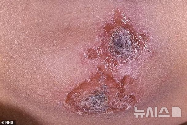 [서울=뉴시스]농가진 모습.(사진=데일리메일)