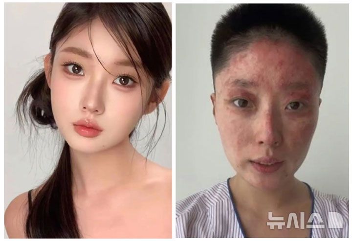 [뉴시스] 중국의 한 SNS 뷰티 인플루언서가 사고로 전신에 화상을 입은 모습을 공개했다. (사진=지무뉴스, 다허바오 편집) 2025.05.30