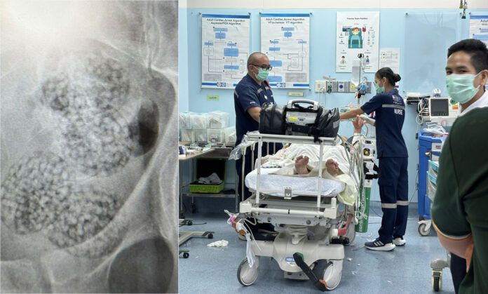 [뉴시스] 몸 속에 마약을 숨겨 밀반출하려다 쓰러진 오스트리아 국적 남성 볼프강 간트너의 모습과 그의 위장 내에 마약이 숨겨져 있는 모습. (사진=카오소드잉글리시) 2025.6.15 *재판매 및 DB 금지