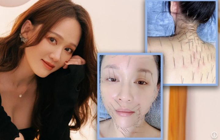 [서울=뉴시스] 대만 배우 천차오언(46·여)은 SNS에 얼굴, 발, 등, 두피에 걸쳐 총 100개가 넘는 실침을 맞는 시술 사진을 공유했다. (사진=SCMP 캡처) 2025.06.16 *재판매 및 DB 금지