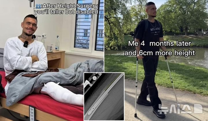 [뉴시스]독일의 한 남성이 23㎝의 키를 연장하기 위해 두 차례나 뼈 연장 수술을 받은 경험을 공개해 화제를 모으고 있다. (사진=데일리메일)