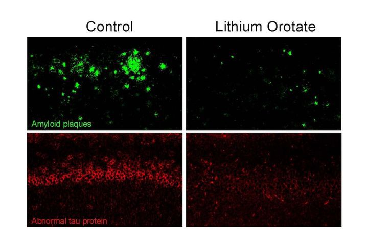 [서울=뉴시스]알츠하이머 치매에 걸린 쥐의 뇌 영상. 쥐를 미량의 리튬 오로테이트로 치료했을 때 아밀로이드 덩어리와 타우단백질 덩어리가 거의 완전하게 제거되는 것으로 나타났다.(출처=하바드 의대, WP에서 재인용) 2025.8.7.  *재판매 및 DB 금지