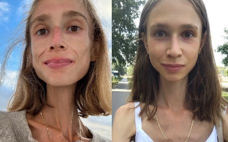 [뉴시스] 과일만 섭취하는 '과일주의'를 고집하다 영양실조로 사망한 20대 여성의 모습. 2025.10.06. (사진=영국 더선 캡처). *재판매 및 DB 금지