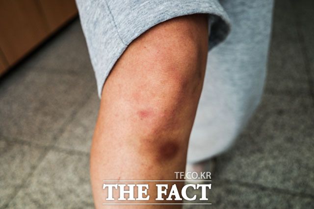 선수들은 잦은 부상에 시달린다. 곳곳에 멍이 든 강하리 선수의 무릎. /괴산=김세정 기자