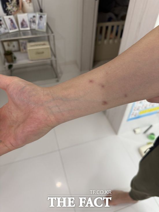 견주 박 싸가 두 달전 '박대송'에게 물린 팔뚝. 아직까지 송곳니 자국이 남아 있다. / 견주 박 씨 제공