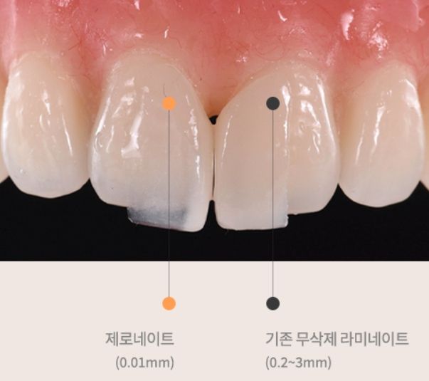 제로네이트의 두께는 0.01㎜로 기존 라미네이트보다 훨씬 얇아 자연치 그대로를 보존한다. 사진 | 티유치과 홈페이지